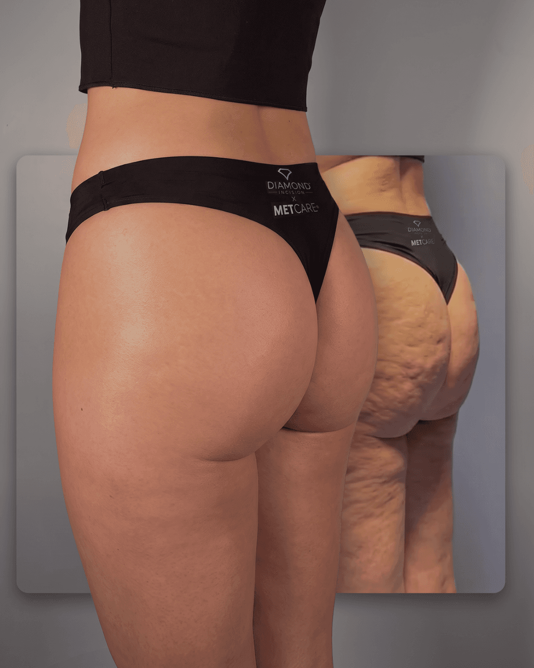 Diamond Incision® × METCARE® — Produits & Protocoles
